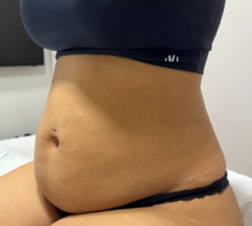 Antes — Barriga
